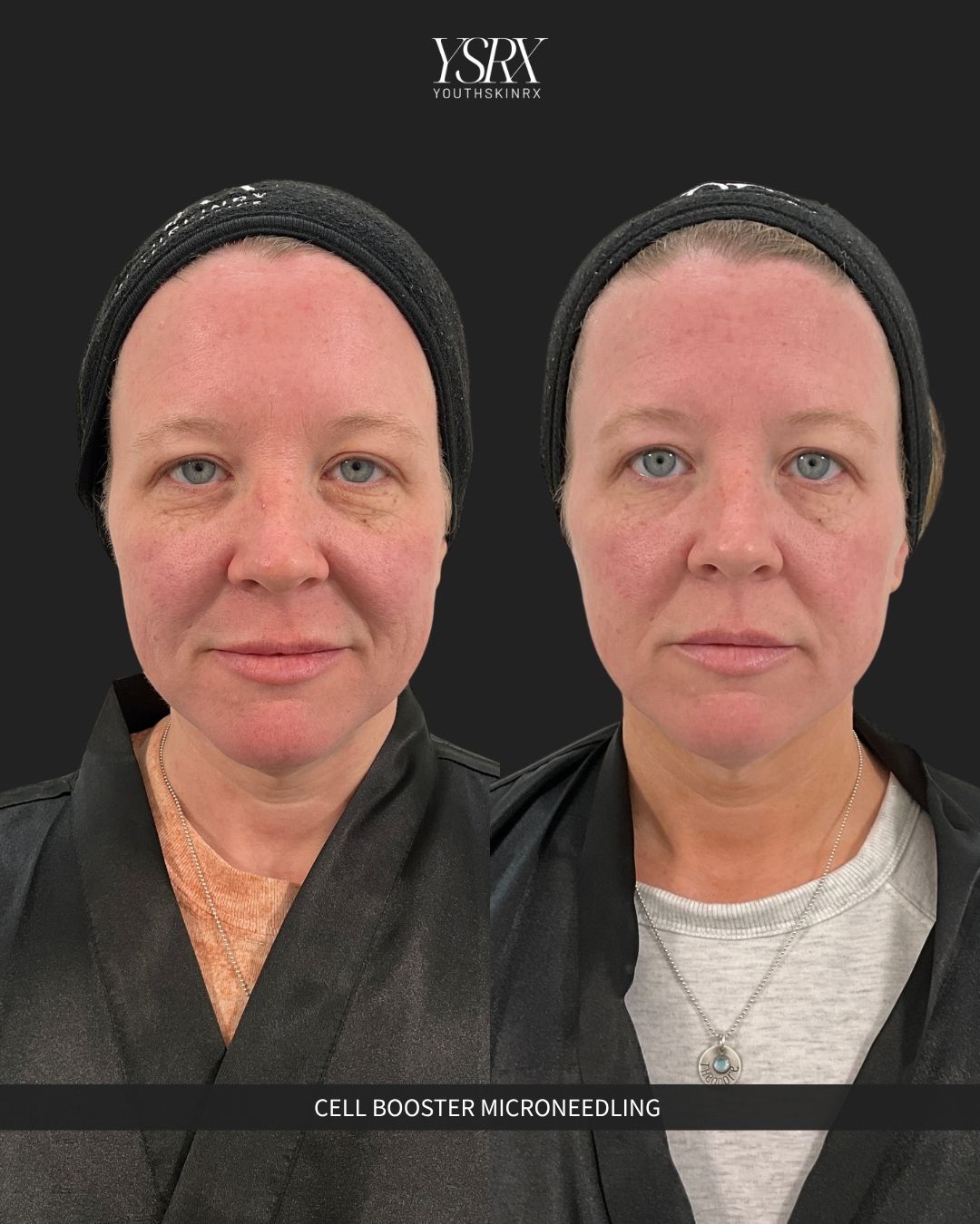 Microneedling & Skin Booster Packages Package B | The Regenerative Glow Trio 2026