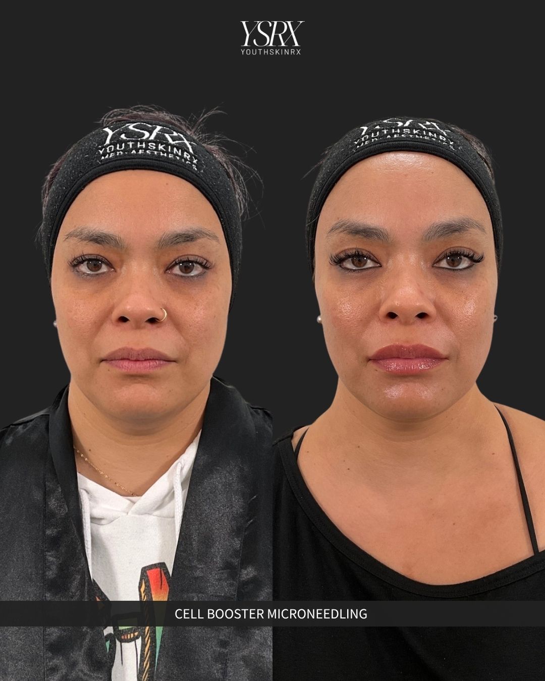 Microneedling & Skin Booster Packages Package C | The Total Skin Transformation Suite 2026