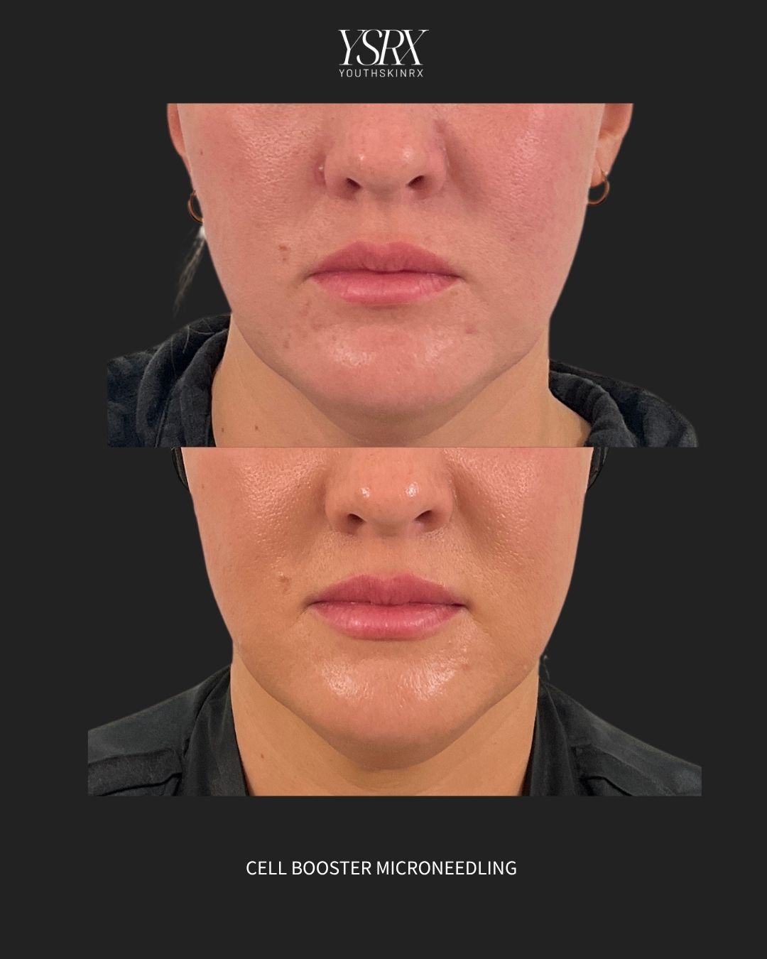 Microneedling & Skin Booster Packages Package A | The Glass-Skin Starter 2026