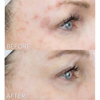 Before and after comparison of a person's eye area after using Rejuran Advanced Intensive Pigment Corrector