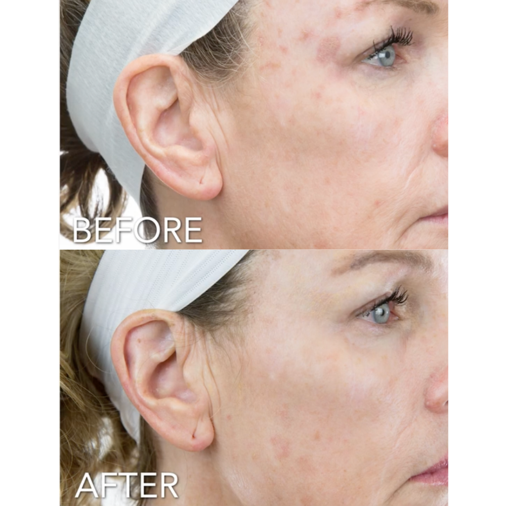 Before and after comparison of a woman's face with acne scars, showing a close-up of the ear and eye area after using Rejuran Advanced Intensive Pigment Corrector