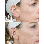 Before and after comparison of a woman's face with acne scars, showing a close-up of the ear and eye area after using Rejuran Advanced Intensive Pigment Corrector