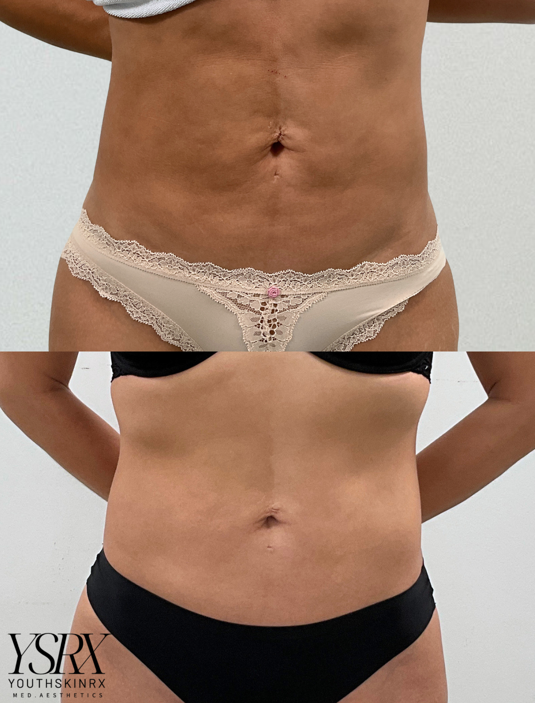 Xerf Skin Tightening